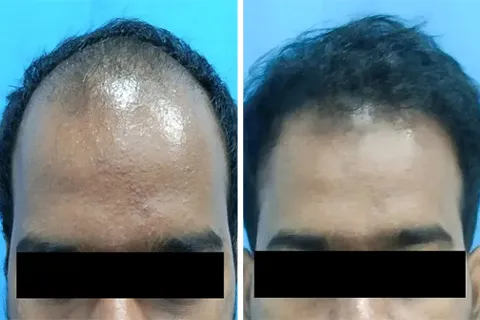 Hair rejuvation therapy before photo in VCare